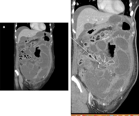 Case Portal Venous Phase Ct In A Year Old Female With A History
