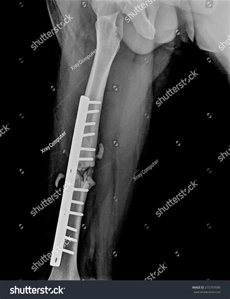 Xray Image Fracture Leg Tibia Implant Stock Photo 215797090 Shutterstock