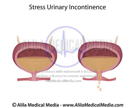 Alila Medical Media Stress Urinary Incontinence Medical Illustration