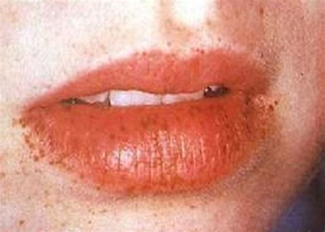 Black Spots On Lips Pictures Causes Treatment Remedies