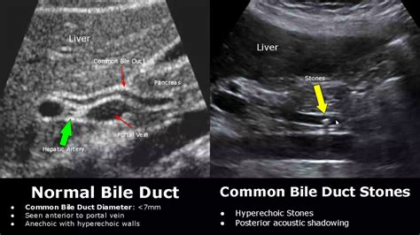 Bile Duct Ultrasound Normal Vs Abnormal Image Appearances Biliary