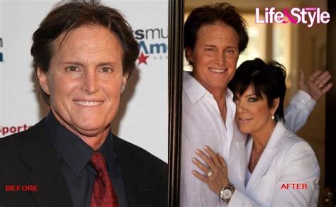 Bruce Jenner Before And After Plastic Surgery The Same Everything Mixed