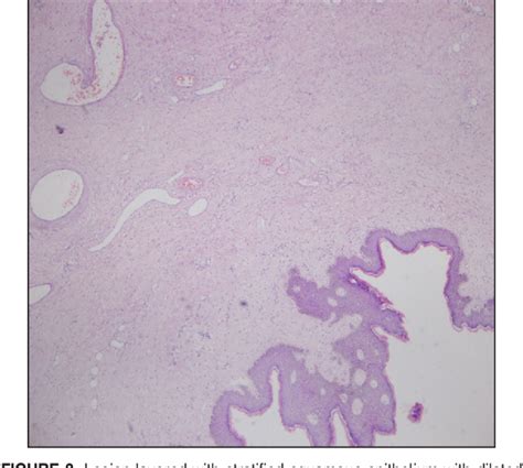 PDF Giant Fibroepithelial Polyp Of Vulva Scientifific Letter