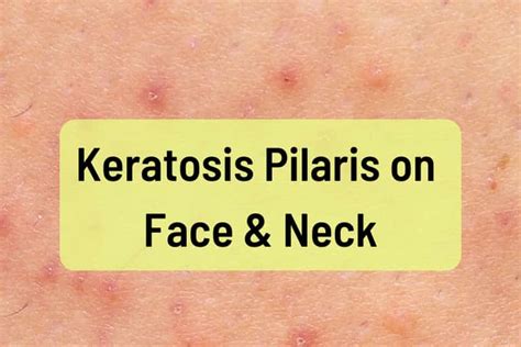 Keratosis Pilaris On Face And Neck Treatment Symptoms Causes