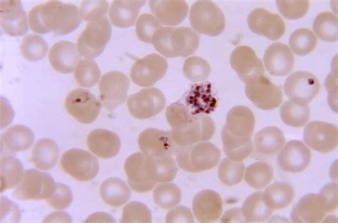 Kostenlose Bild Blutausstrich Kompakt Alt Trophozoite Plasmodium Malariae