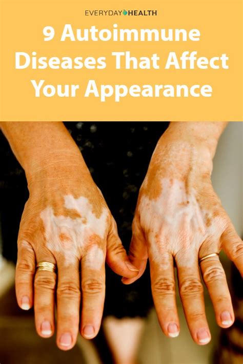 Autoimmune Skin Diseases And Rashes That Affect Appearance In 2019