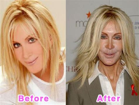 Celebrity Plastic Surgery Before And After Photos 16 Pics Izismile Com