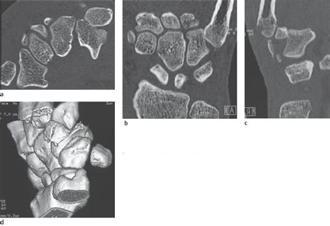 24 Carpometacarpal Dislocations And Fracture Dislocations Radiology Key