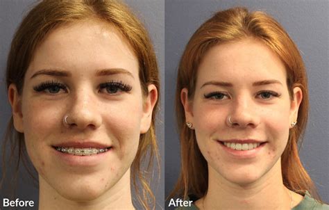 Orthognathic Surgery All Alaska Oral Craniofacial Surgery