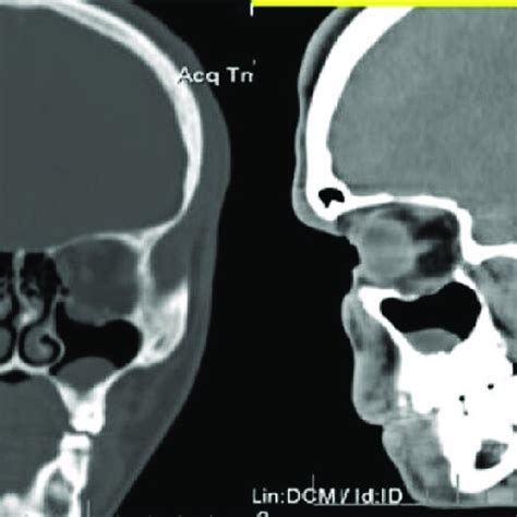 The Computed Tomography Scan Shows An Orbital Floor Fracture And Download Scientific Diagram