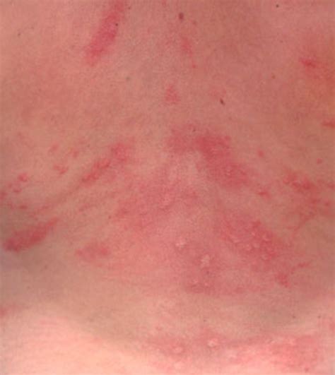 Itchy Rash On Back Hubpages