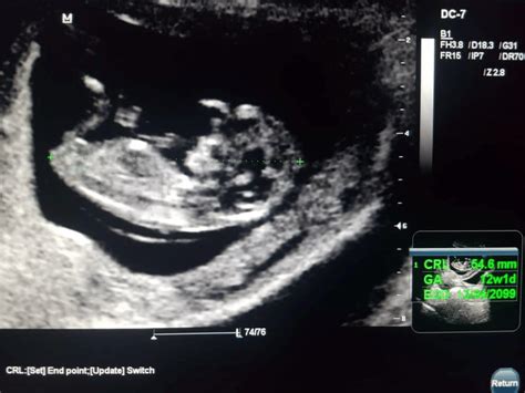 Ultrasound Of Male Fetus At Weeks Download Scientific Diagram