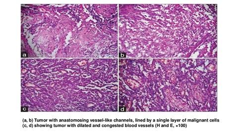 Histopathological Variants Of Squamous Cell Carcinoma