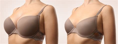Breast Implant Shapes And Sizes Choosing The Right One For You