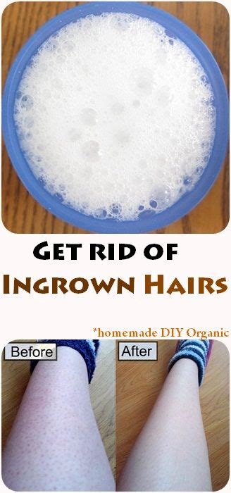 Cute Dyed Hair How To Get Rid Of Ingrown Hair Bumps On Legs