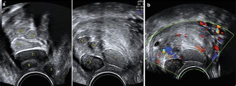 Ultrasound Evaluation Of The Cervix Obgyn Key