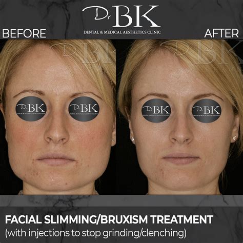 Before And After Gallery Drbk Cosmetic Dentist And Aesthetics Clinic
