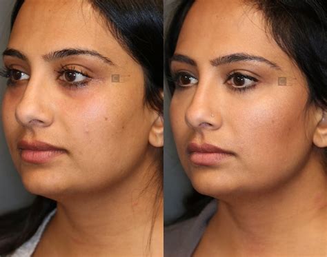 Patient 36534263 Wrinkle Relaxer Before And After Clinic 5c