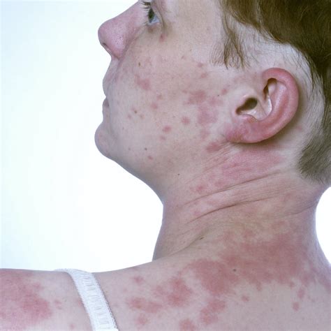Different Types Of Hives And Causes Hivesurticaria Guide
