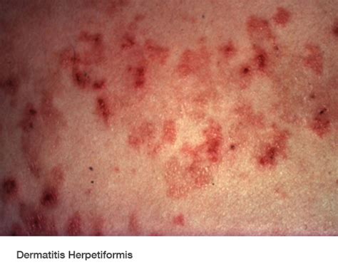 Coeliac Disease And Dermatitis Herpetiformis Glutafin