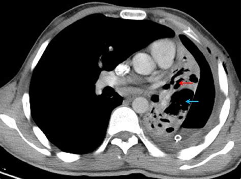 Contrast Enhanced Ct Scan Shows Marked Shifting Of The Mediastinum