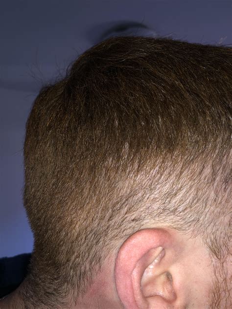 Is This Retrograde Alopecia Rhairloss