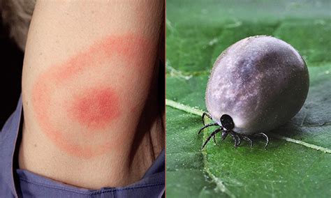 Lyme Disease Tick Bite Pictures