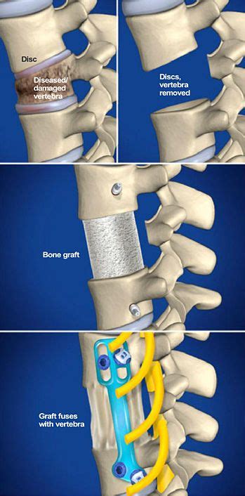 Pin On Surgical Procedures At Southeastern Spine