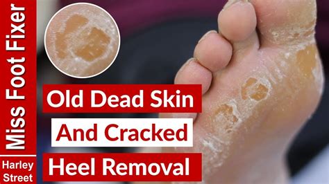 Thick Dead Skin On Feet Removal How To Heal Dry Cracked Heels