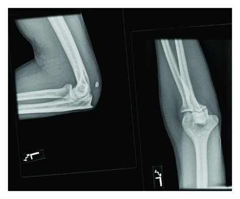 Plain Radiograph Left Elbow With Avulsion Fracture Download