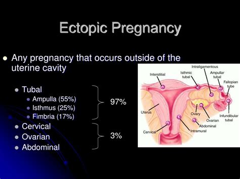 Ppt Early Pregnancy Complications Powerpoint Presentation Free