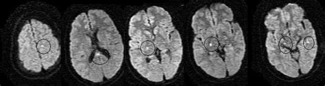 Neuroradiology Cases Diffuse Axonal Injury Mri