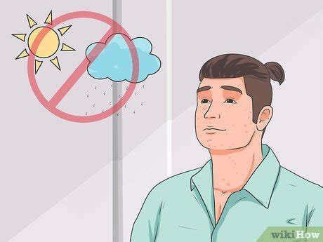 Read more for causes, symptoms and treatment of chicken pox. 3 Cara untuk Mengobati Cacar Air - wikiHow