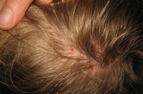 How To Get Rid Of Lice Insight Pest Solutions