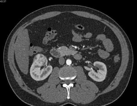 Renal Cell Carcinoma Right Kidney On Multiple Phases Kidney Case