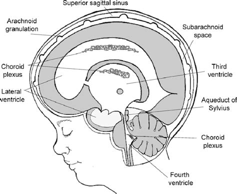 Schematic Representation Of Marked Hydrocephalus With An Enormously