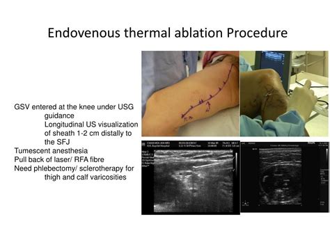 Ppt Endovenous Thermal Ablation For Varicose Vein Powerpoint