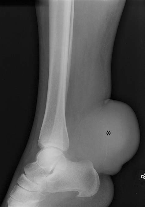 Atypical Imaging Features Of Bilateral Achilles Tendon Xanthomatosis