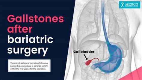 Gallstones After Weight Loss Surgery Gallbladder Disease And Removal