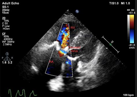 Case Of Calcific Tricuspid And Pulmonary Valve Stenosis Bmj Case Reports