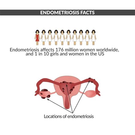 all you need to know about endometriosis part 1 in the stork® otc blog