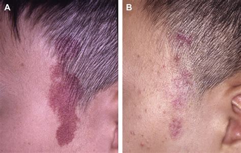 Capillary Malformations Portwine Stains Of The Head And Neck