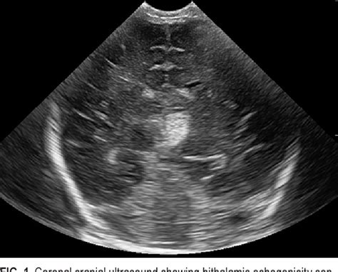 Figure 1 From Blunt Prenatal Trauma Resulting In Fetal Epidural Or