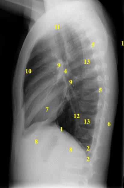 Note the larger appearing heart on the ap view. Approach to the Chest X-ray (CXR) - Undergraduate ...