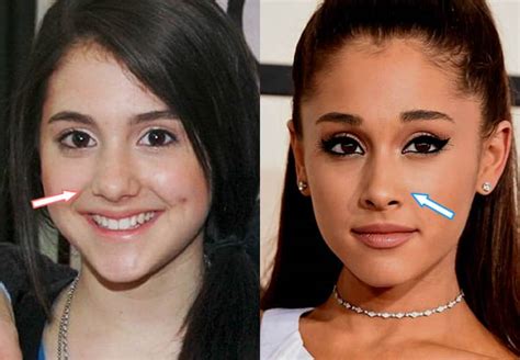 Did Ariana Grande Have Plastic Surgery Before And After 2021