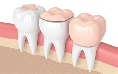 Dental Inlays Onlays San Antonio