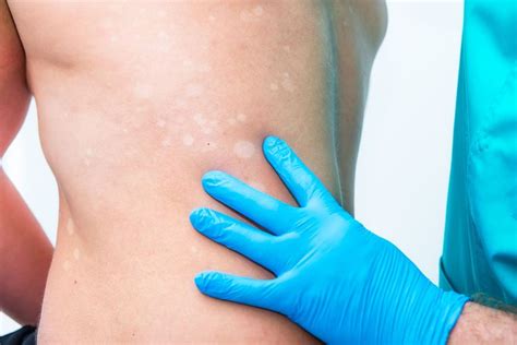 Remove White Spots Skin Tratamiento Del Vitiligo Manchas Piel