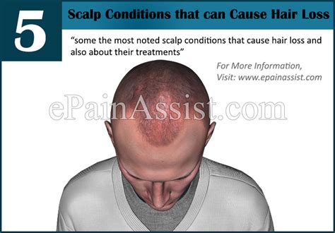 Scalp Conditions That Cause Hair Loss And Its Treatment
