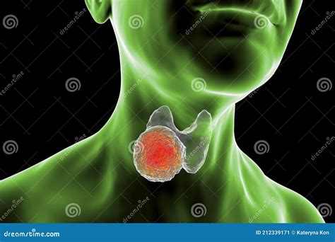 Thyroid Cancer In Women Stock Illustration Illustration Of Gland