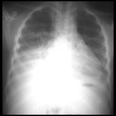 Pediatric Acute Chest Syndrome Pediatric Radiology Reference Article